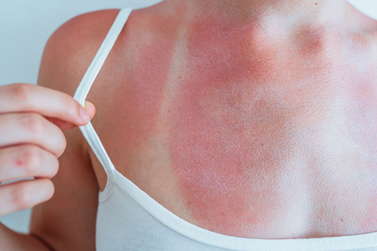 Sonnenbrand im Hohenlohekreis: Richtig vorbeugen, schnell be